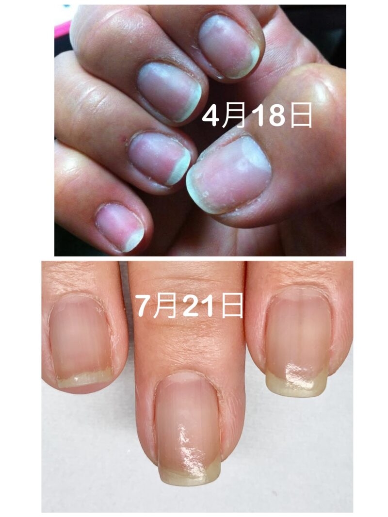 短く痛んだ爪から健康になった爪の変化