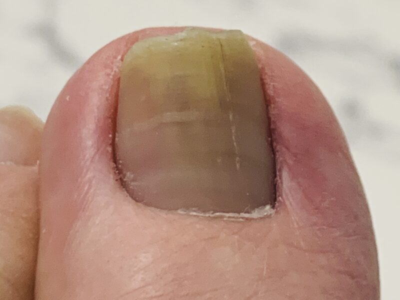 白癬菌に感染した足の爪