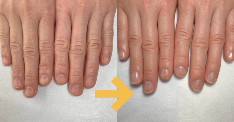 手元のシワがなくなり若返った手