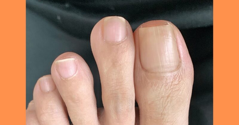 適切な足の爪の形