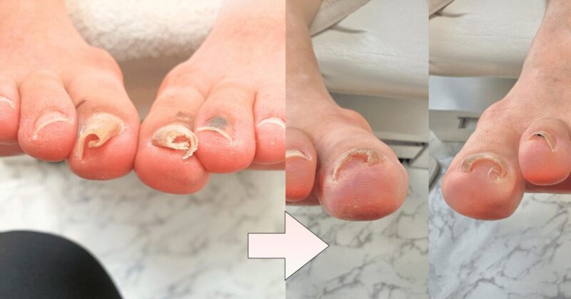 巻き爪のBeforeAfter写真