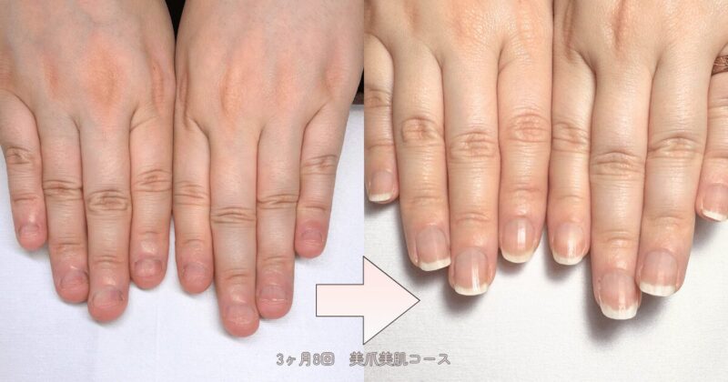 深爪から縦長の美爪になった30代Aさん