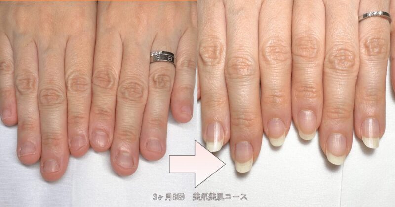 深爪から縦長の美爪になった40代Bさん