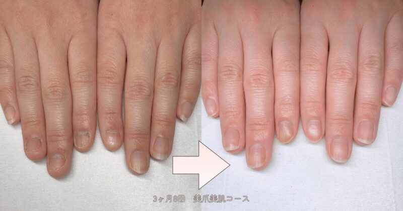 深爪から縦長の美爪になった30代Cさん