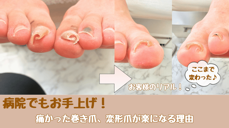お客様の巻き爪BeforeAfter症例