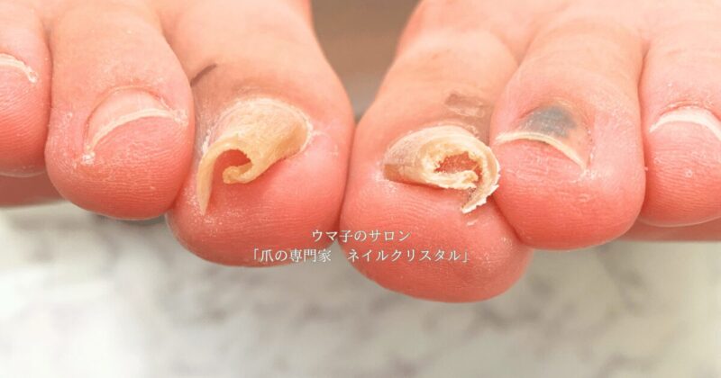 巻き爪Before
