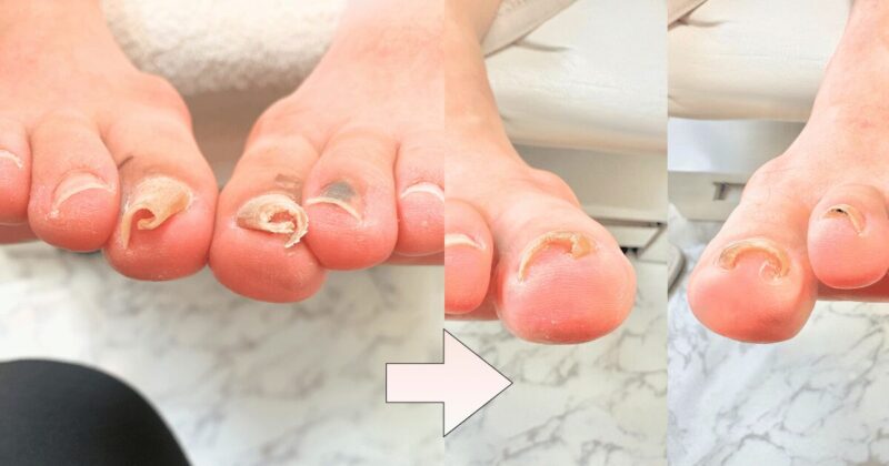 巻き爪ケア改善事例