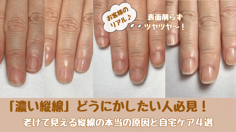 ネイルケアの縦線ビフォーアフター