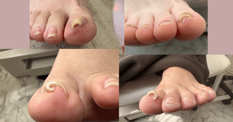 巻き爪の症例