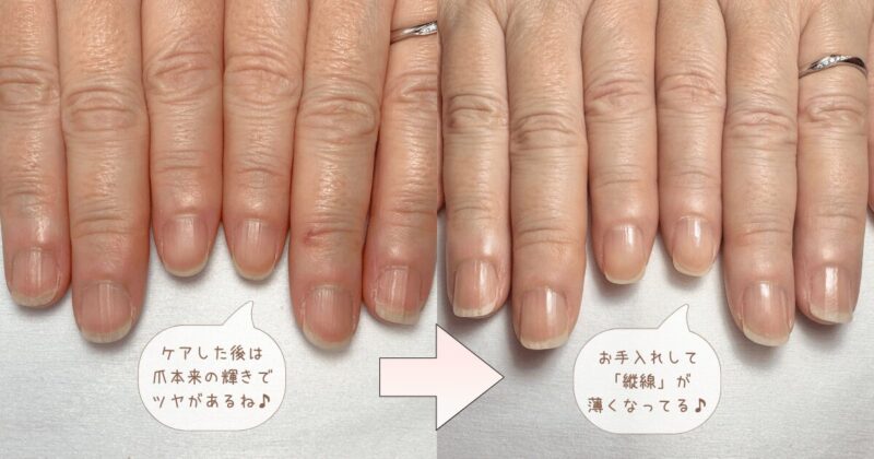 ケア後の爪の縦線BeforeAfter