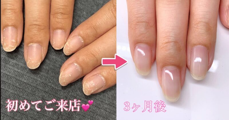 ボロボロの爪から綺麗になったBeforeAfter
